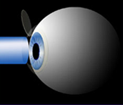 lasik eye surgery spring texas